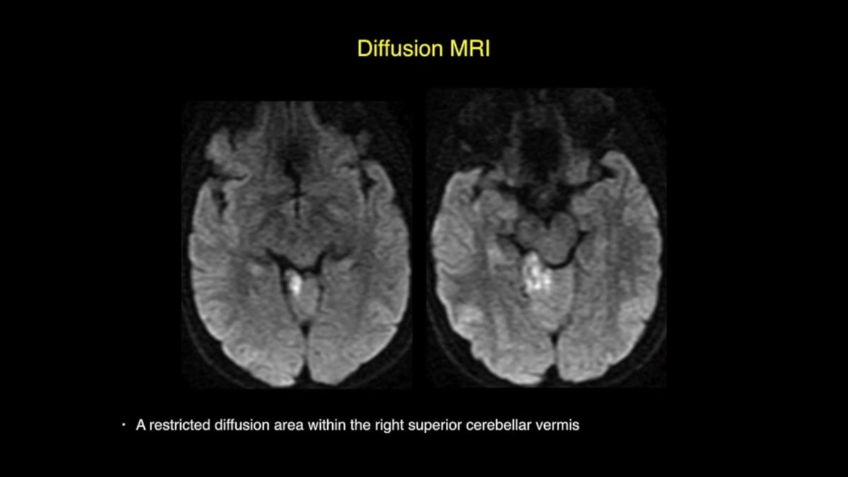 DrBaskaya's tweet image. 39y M #hemangioblastoma embolized with #onyx, woke up with no sensation in R face, DWI: small restricted diffusion within R superior cerebellar vermis, GTR was uneventful, extruded onyx on #trigeminal nerve &amp;amp; #brainstem was not removed 
youtu.be/s0DjD26Xkas
#nsgy #microsurgery