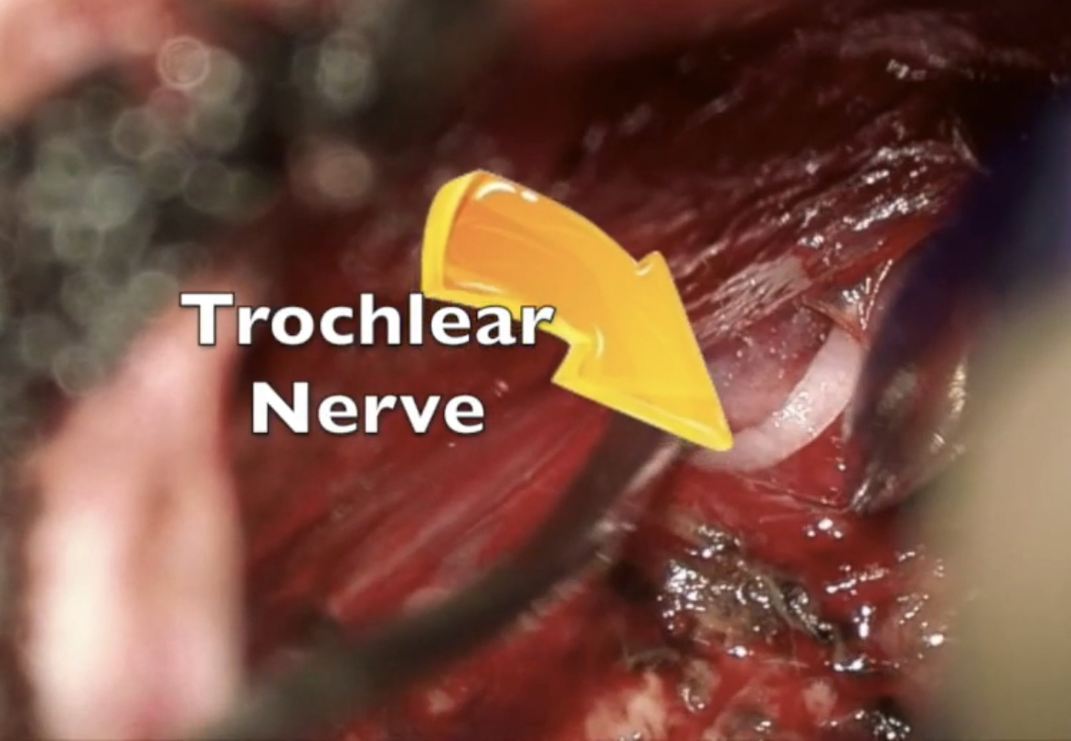 DrBaskaya's tweet image. 39y M #hemangioblastoma embolized with #onyx, woke up with no sensation in R face, DWI: small restricted diffusion within R superior cerebellar vermis, GTR was uneventful, extruded onyx on #trigeminal nerve &amp;amp; #brainstem was not removed 
youtu.be/s0DjD26Xkas
#nsgy #microsurgery