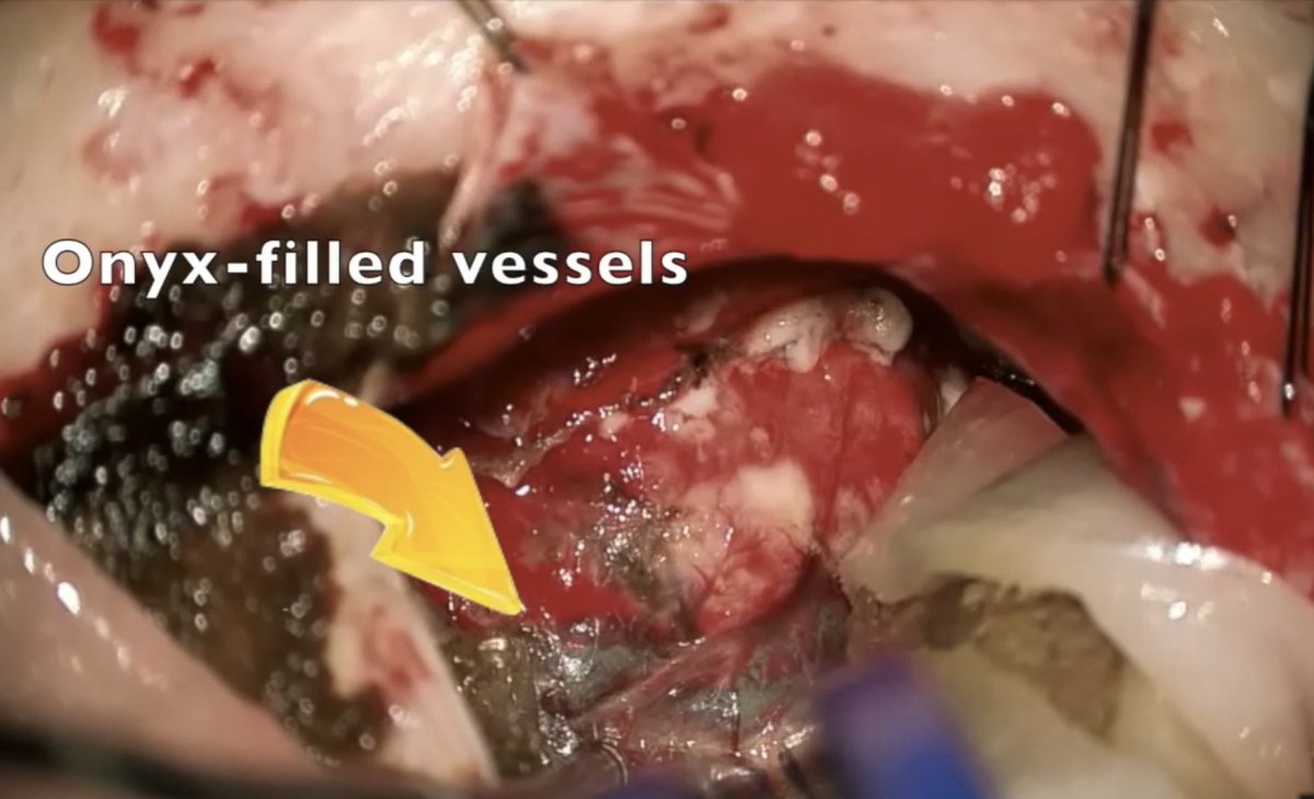 DrBaskaya's tweet image. 39y M #hemangioblastoma embolized with #onyx, woke up with no sensation in R face, DWI: small restricted diffusion within R superior cerebellar vermis, GTR was uneventful, extruded onyx on #trigeminal nerve &amp;amp; #brainstem was not removed 
youtu.be/s0DjD26Xkas
#nsgy #microsurgery