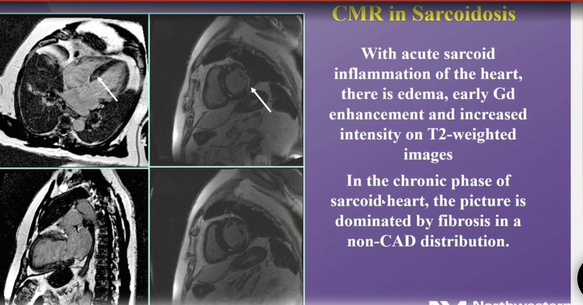 hvanspall's tweet image. #ESCCongress #MultimodalityImaging in #CardiacSarcoid presented by James Thomas @NMCardioVasc.
Case of a young man presenting with narrow complex tachycardia (ventricular origin). Had wall motion abn’s in nonvascular distribution on Echo, normal coronaries.
Teaching points👇🏼1/2