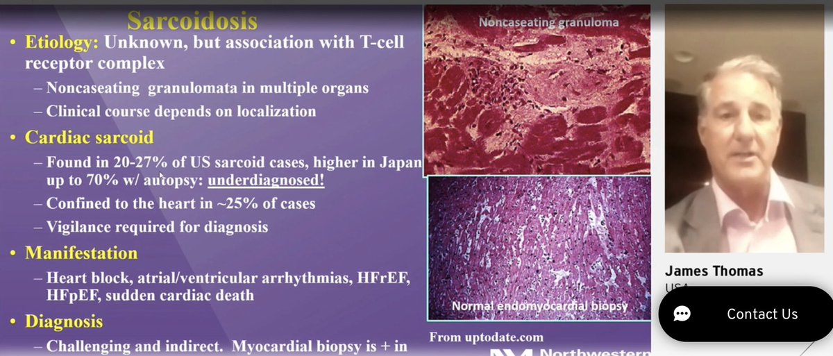 hvanspall's tweet image. #ESCCongress #MultimodalityImaging in #CardiacSarcoid presented by James Thomas @NMCardioVasc.
Case of a young man presenting with narrow complex tachycardia (ventricular origin). Had wall motion abn’s in nonvascular distribution on Echo, normal coronaries.
Teaching points👇🏼1/2