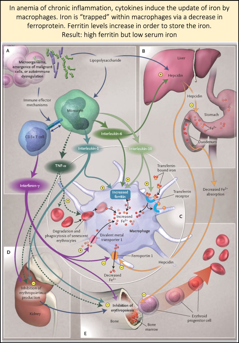 6/But, ferritin is an acute phase reactant. IL-1, IL-6, and other cytokines lead to an increase in synthesis by macrophages and hepatocytes.And, iron is taken up by macrophages of the reticuloendothelial system. Once inside, the iron is "trapped". https://pubmed.ncbi.nlm.nih.gov/15758012/ 