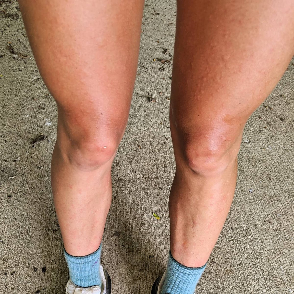 Thee_Mac_Attack's tweet photo. Checked out one of our new State Forests today. The forest is there but the trails are NOT cleared yet. Epic bushwhack rash though... 🤣🌾😣 #RaviniaStateForest https://t.co/KFGXYIdtJV