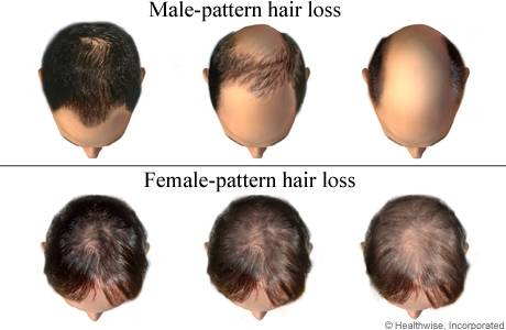 Hairstyles For Thinning Hair  Causes And Treatments To Stop Hair Loss