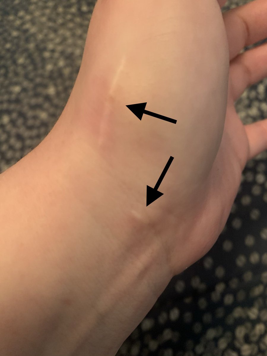 He even went into detail about how his stitches would differ bc of my hEDS, and how ugly the scars were from other docs that didn't know better. Picture shows example of scars from thumb and wrist surgery. 13/