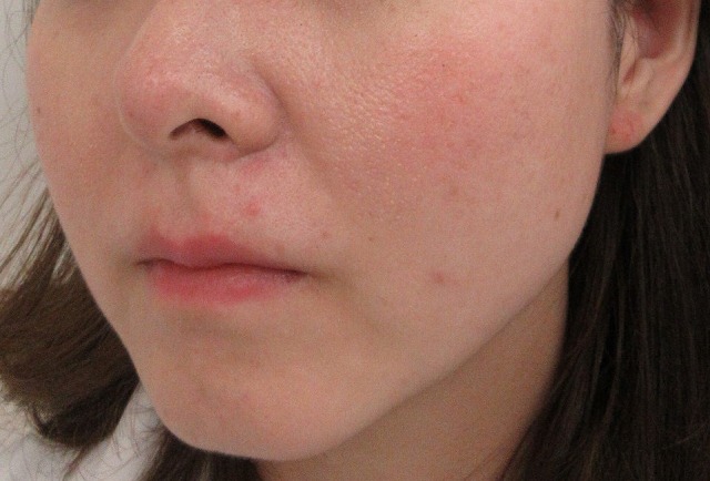 六本木境クリニック 小顔施術は皮膚が余るので全てたるむけど それぞれ特徴がある 輪郭形成 両顎骨切り バッカルファット除去 シャレにならないくらいメチャメチャたるんでいる人がいる ハイフ エラボト 何となく老けたたるんだ上述のものより 六本木境クリニック 小顔施術は皮膚が余るので全てたるむけど それぞれ特徴がある 輪郭形成 両顎骨切り バッカルファット除去 シャレにならないくらいメチャメチャたるんでいる人がいる ハイフ エラボト 何となく老けたたるんだ上述のものより