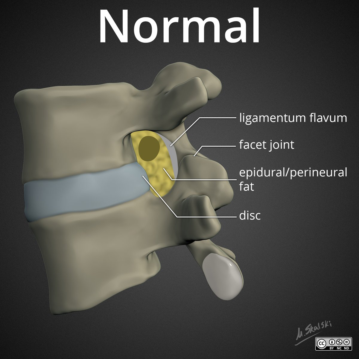 docskalski's tweet image. Not sure why I didn&apos;t do this long, long ago... but just wrote a short @Radiopaedia article on lumbar foraminal stenosis and uploaded some diagrams I had lying around to flesh it out. #FOAMrad bit.ly/2Gc0l1t