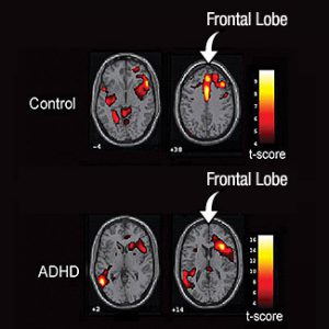 It doesn't make anyone worth more or less!I have ADHD. My brain is different from neurotypicals' brains. It doesn't hurt to admit it, even though society expects me to behave like a neurotypical. Have a look at the images. ADHD brains compared to neurotypical brains.
