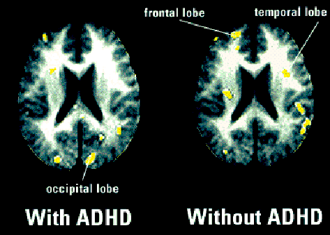 It doesn't make anyone worth more or less!I have ADHD. My brain is different from neurotypicals' brains. It doesn't hurt to admit it, even though society expects me to behave like a neurotypical. Have a look at the images. ADHD brains compared to neurotypical brains.