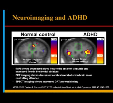 It doesn't make anyone worth more or less!I have ADHD. My brain is different from neurotypicals' brains. It doesn't hurt to admit it, even though society expects me to behave like a neurotypical. Have a look at the images. ADHD brains compared to neurotypical brains.