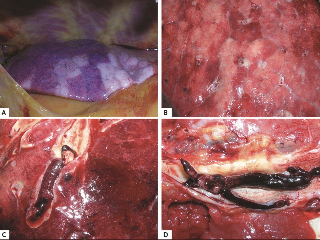 2/ Injury from SARS-CoV-2 virus is mediated by how much swelling (inflammation) and blood flow abnormalities (clotting and bleeding) occur, it’s wise to review what we know about SEPSIS, ARDS, & the BRAIN.