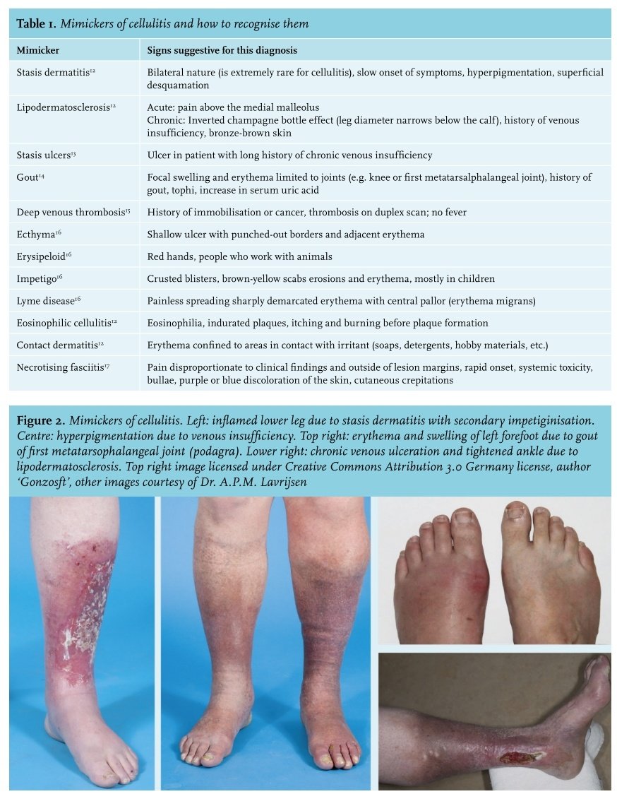 Diagnosis and Management of Cellulitis and Abscess in the Emergency  Department Setting: An Evidence-Based Review - Journal of Emergency Medicine, image size:874x1124
