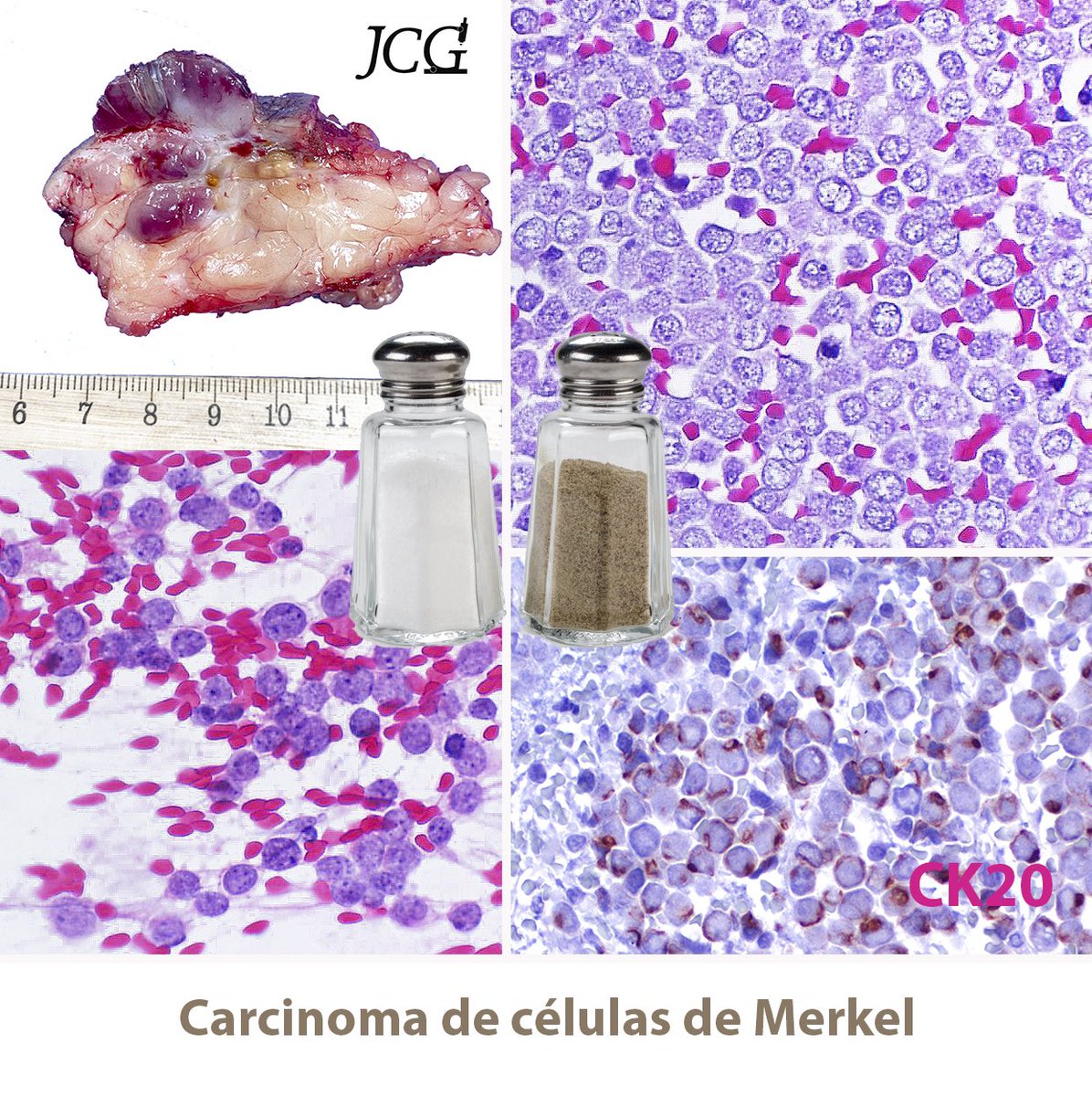JCGarcesPath's tweet photo. #MerkelCell #carcinoma. Aggressive #cutaneous #neuroendocrine #malignancy. #polyoma #virus #saltAndPepper #nuclei @MSLDermatopato gave us an extraordinary lecture about this tumor yesterday https://t.co/iQ5MtRXOf0