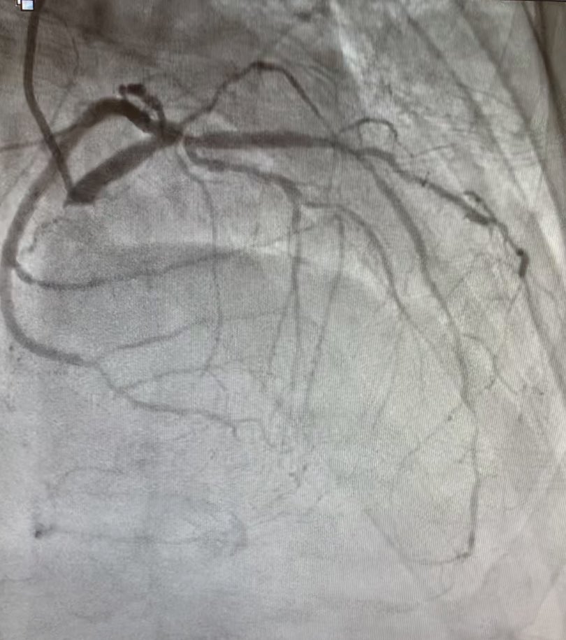 istentem's tweet image. #protectedpci #RadialFirst #impella #safefemoral#ivus##unprotectedleftmainpci 61f#nstemi.6f45pinnacle inside 14f sheath .Successful #LMpci .left cfa occluded. bailout 014”grand slam/8x2balloon via rt radial. failed preclose ,safe balloon hemostasis while act240sec.#NoHematoma