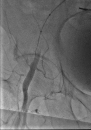 istentem's tweet image. #protectedpci #RadialFirst #impella #safefemoral#ivus##unprotectedleftmainpci 61f#nstemi.6f45pinnacle inside 14f sheath .Successful #LMpci .left cfa occluded. bailout 014”grand slam/8x2balloon via rt radial. failed preclose ,safe balloon hemostasis while act240sec.#NoHematoma
