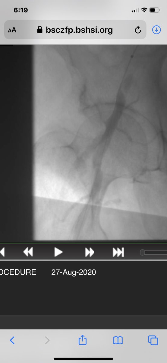 istentem's tweet image. #protectedpci #RadialFirst #impella #safefemoral#ivus##unprotectedleftmainpci 61f#nstemi.6f45pinnacle inside 14f sheath .Successful #LMpci .left cfa occluded. bailout 014”grand slam/8x2balloon via rt radial. failed preclose ,safe balloon hemostasis while act240sec.#NoHematoma