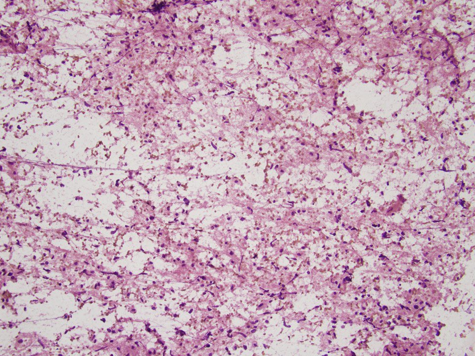 SamKhader's tweet photo. #Cytopathology is always helpful!
A squash prep during a frozen section for a neurological tumor. Pleomorphic cells with cytoplasmic extensions, suggestive of a high grade astrocytoma. IHC is +ve for GFAP. NGS is +ve for IDH1 mutation. The final Dx is glioblastoma. @SaeedAsiry https://t.co/SKE6v7CSBO