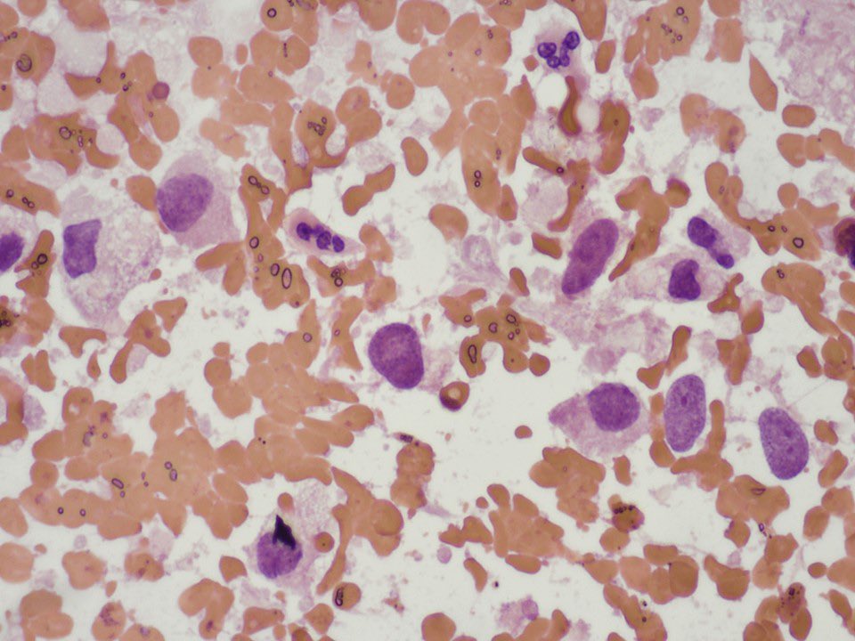SamKhader's tweet photo. #Cytopathology is always helpful!
A squash prep during a frozen section for a neurological tumor. Pleomorphic cells with cytoplasmic extensions, suggestive of a high grade astrocytoma. IHC is +ve for GFAP. NGS is +ve for IDH1 mutation. The final Dx is glioblastoma. @SaeedAsiry https://t.co/SKE6v7CSBO