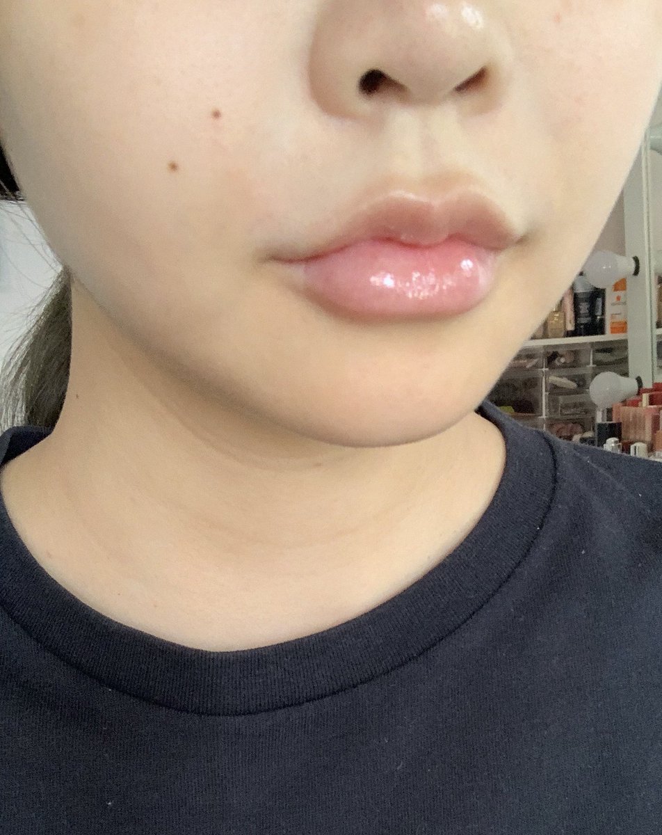 fhay_cotton_h's tweet photo. Botox + meso fat ของ Tob1 clinic คือขลังจริง5555555 นี่ฉีดมาจะครบ 3 วีคแล้ว คือเล็กลงเรื่อยๆเลย ไม่เคยหน้าเรียวขนาดนี้มาก่อน 😭 https://t.co/NWUXv8aCl1