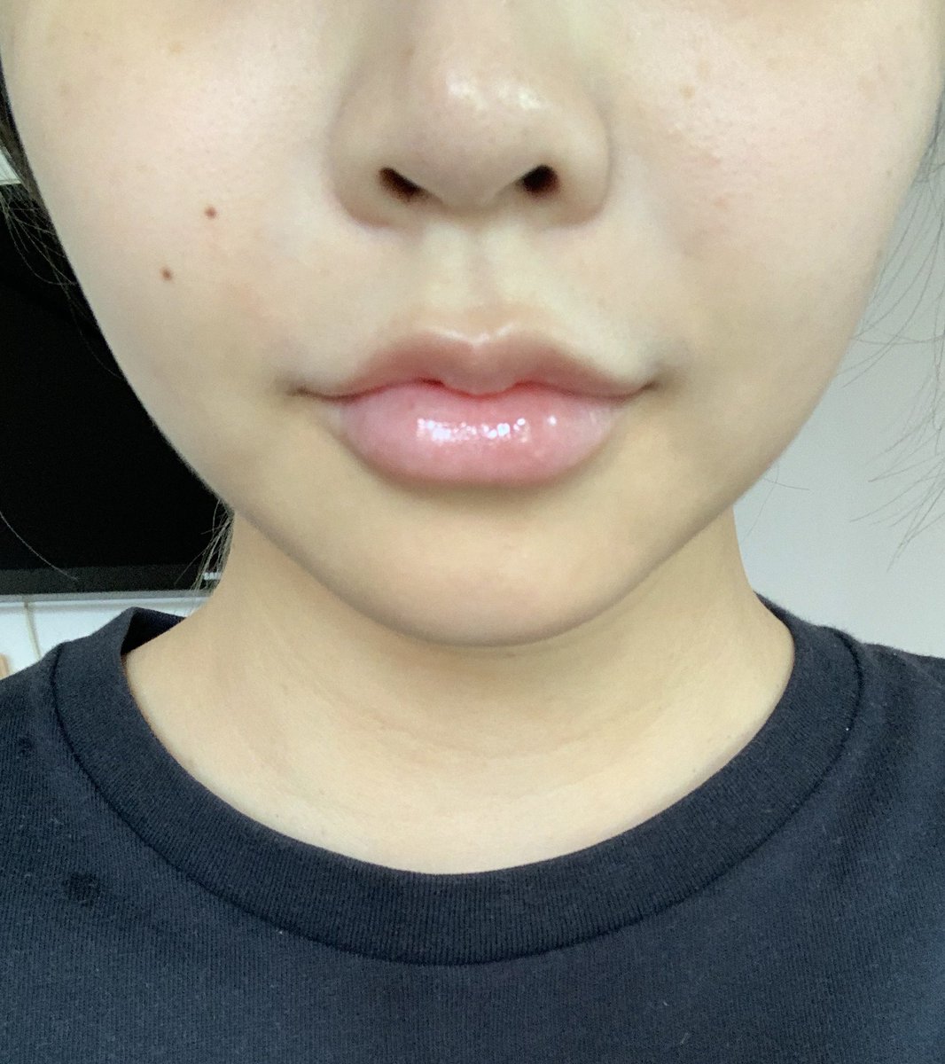 fhay_cotton_h's tweet photo. Botox + meso fat ของ Tob1 clinic คือขลังจริง5555555 นี่ฉีดมาจะครบ 3 วีคแล้ว คือเล็กลงเรื่อยๆเลย ไม่เคยหน้าเรียวขนาดนี้มาก่อน 😭 https://t.co/NWUXv8aCl1