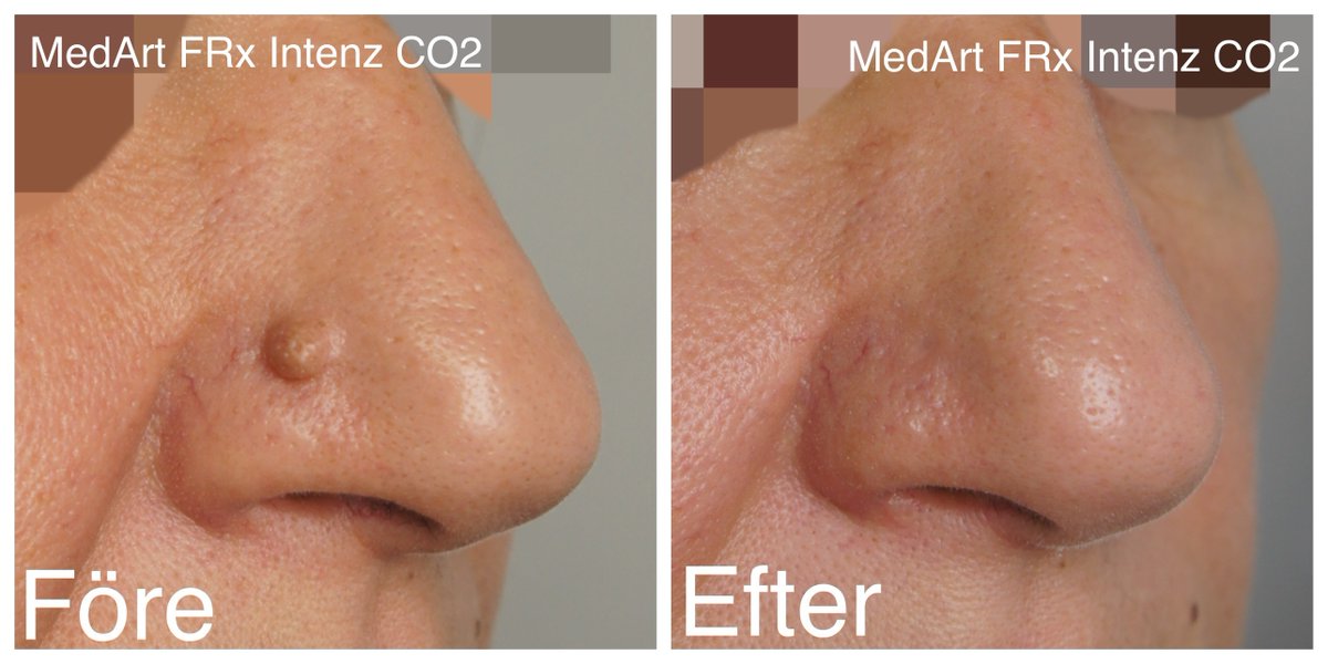 a_medart's tweet photo. Treatment of dermal nevus removed by MedArt FRx Intenz CO2 
Only ONE Treatment, Fast&amp;Effective. 
MedArt FRx Intenz CO2 support: 
👍both Ablative &amp; 👍Non-Ablative,
Surgical &amp; Fractional treatments. A versatile Compact, portable system and NO consumable #moleskine  #dermatologist https://t.co/Um4o4x47Or