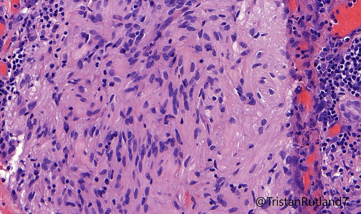 Tristan Rutland MBBS FRCPA IFCAP (@tristanrutland7) on Twitter photo Omentum
@ZHOUSEH @MattieFarzin <a href="/DrGeeONE/">Olaleke Folaranmi</a> <a href="/Dr_Brian_Cox/">Brian Cox, MD, MAS</a> <a href="/ariella8/">Celina Stayerman MD</a> <a href="/RunjanChetty/">Runjan Chetty</a> <a href="/DrBMcGinn/">Barry McGinn</a>
#PathTwitter #surgpath #pathology Omentum
@ZHOUSEH @MattieFarzin <a href="/DrGeeONE/">Olaleke Folaranmi</a> <a href="/Dr_Brian_Cox/">Brian Cox, MD, MAS</a> <a href="/ariella8/">Celina Stayerman MD</a> <a href="/RunjanChetty/">Runjan Chetty</a> <a href="/DrBMcGinn/">Barry McGinn</a>
#PathTwitter #surgpath #pathology