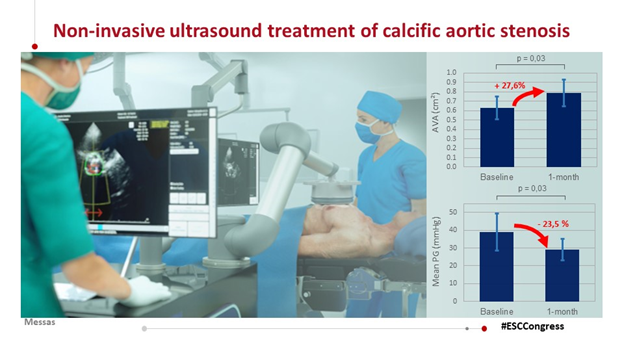 aayshacader's tweet photo. #ESCCongress #ESCAbstracts @escardio 

#Firstinman:Prof Emmanuel Messas reports non-invasive ultrasound therapy is feasible&amp; safe in patients with severe calcific #aorticstenosis ;improves AVA and pressure gradient in some patients
👉https://t.co/FaFswqRBz3

@tavrkapadia @Tabaza https://t.co/JP6vn8O5IE
