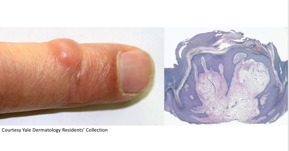 ChristineJKoMD's tweet photo. What's your #diagnosis? Short #clinpathcorrelation answer video at https://t.co/vIrOsF53SY #cpKo #MedStudentTwitter #Skin https://t.co/tnca1l30m8