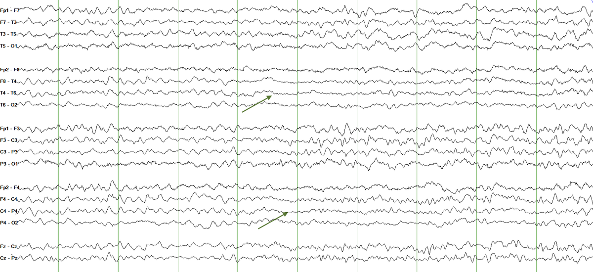 About an hour into the study, you start seeing some changes on the right side. You can appreciate more prominent theta slowing, a loss of faster frequencies and even some attenuation (green arrow pointing to a more obvious portion). 4/