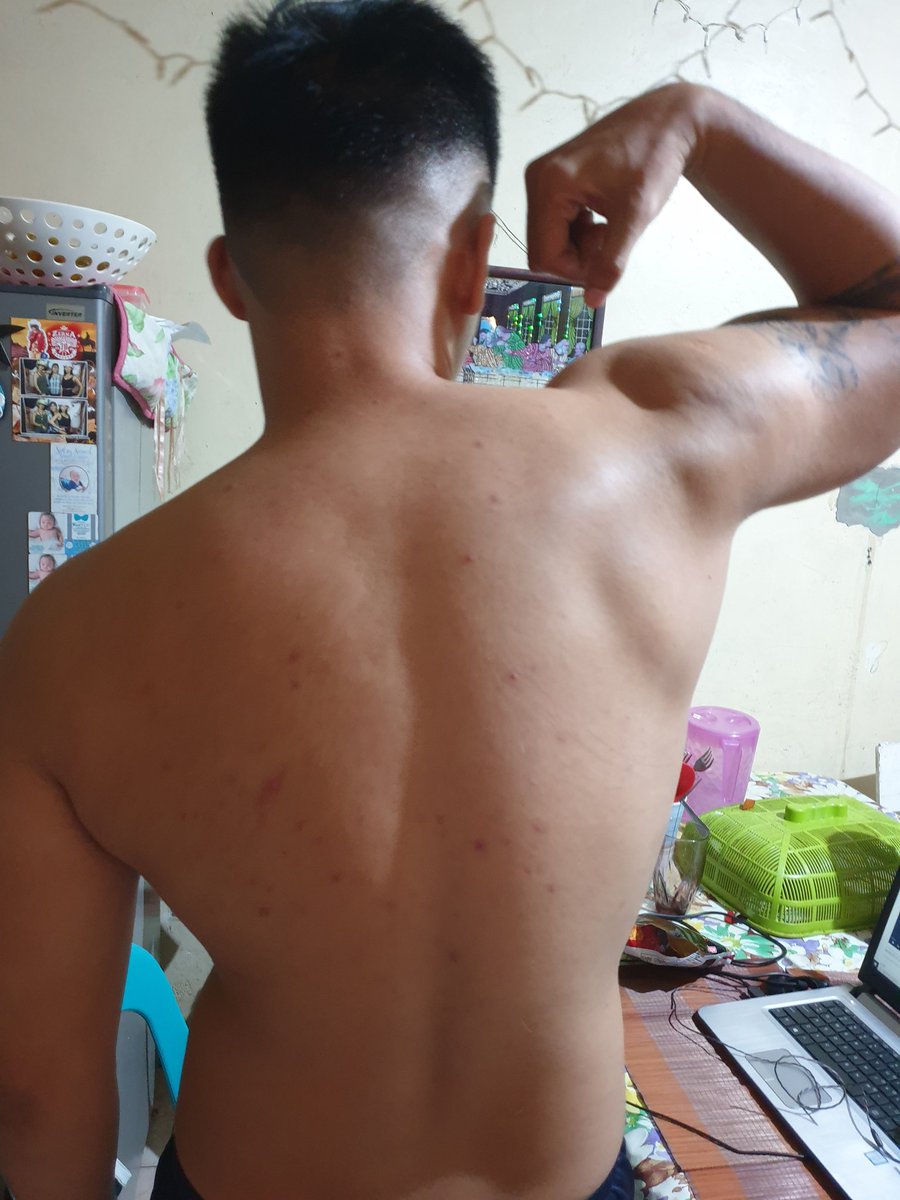 Keylan_RV's tweet photo. Pimples in my back. Hahah https://t.co/LUM0j7zz75