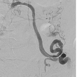 #OBGYN in IR! 30s F with spontaneous #PostPartumHemorrhage after vaginal delivery. Left pelvic #pseudoaneurysm treated with left ovarian artery glue #embolization ... #twittIR #WomensHealth #YouW #IRad #RadRes #IamIR 
@UWRadiology @SIRRFS