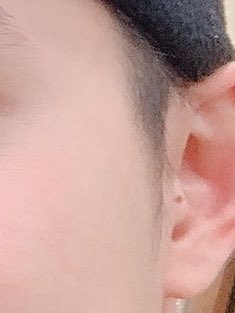 EAR MOLE AND YES!!! BALDSOO 