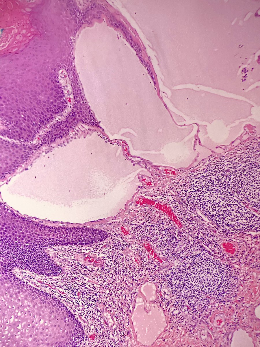 martinwpath's tweet photo. Lymphangioma: large lymphatic channels in loose connective tissue with associated lymphoid aggregates. Usually well circumscribed with focal cystic formation. May be due to lymphovascular malformation. CD31/CD34/D2-40 (+). https://t.co/VeuqnUuJC0