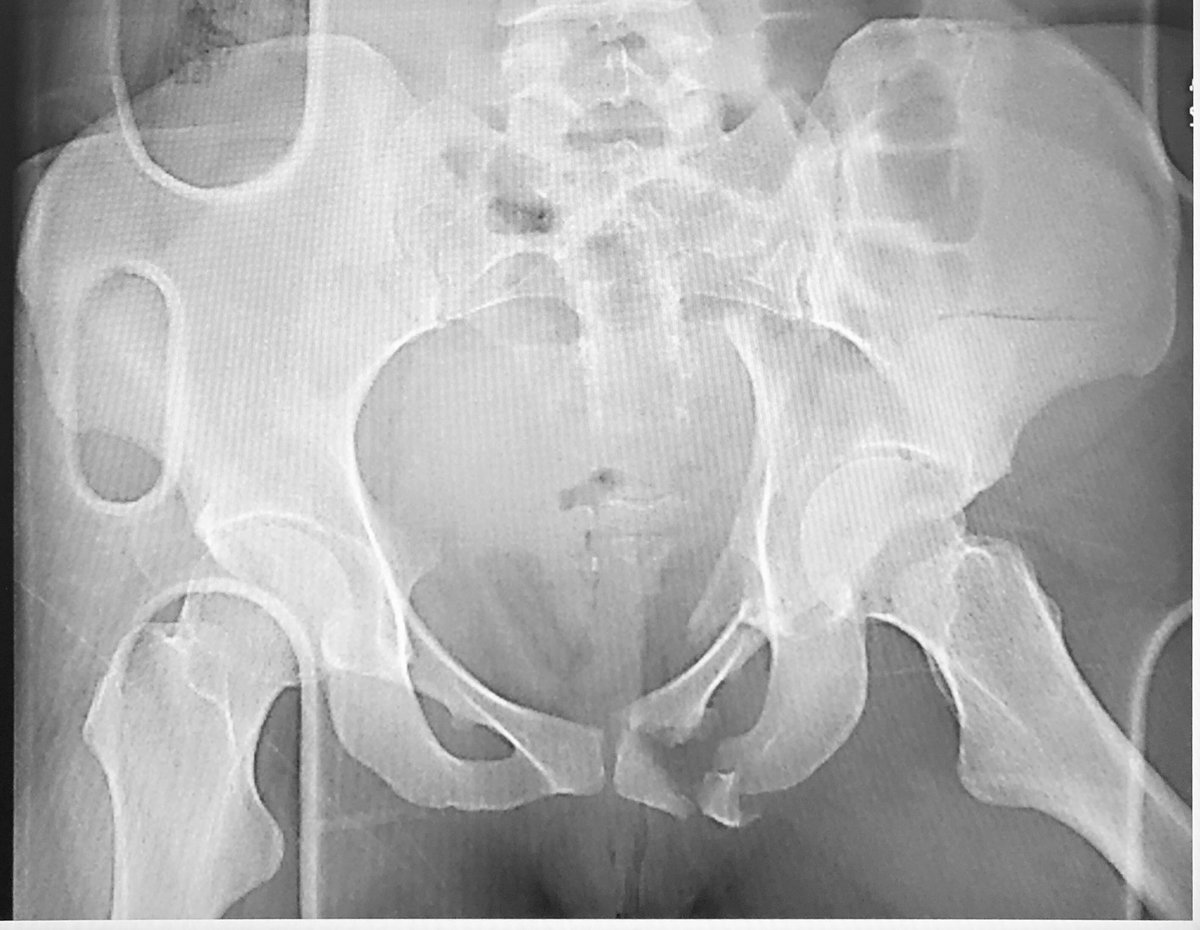 You can “train your brain” to see the surface rendered image when you look at the plain AP pelvic film - you just have to practice and work at it with numerous examples - soon you will be seeing so much and so many more details on plain films! Train and Work -   #UCanDoIt