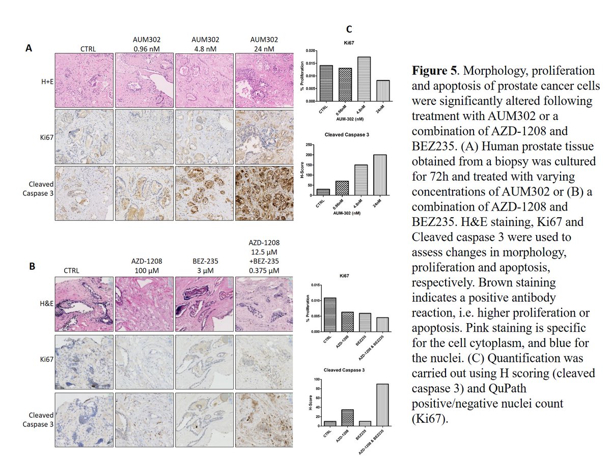 (8/13) Fig5: In human  #exvivo cultures, we see the same story, with improved inhibition of proliferation & induction of apoptosis when we co-target both pathways. Note the conc differences!This fig is a taster of the work to be expanded on in my new lab  #comingsoon  #heaveylab