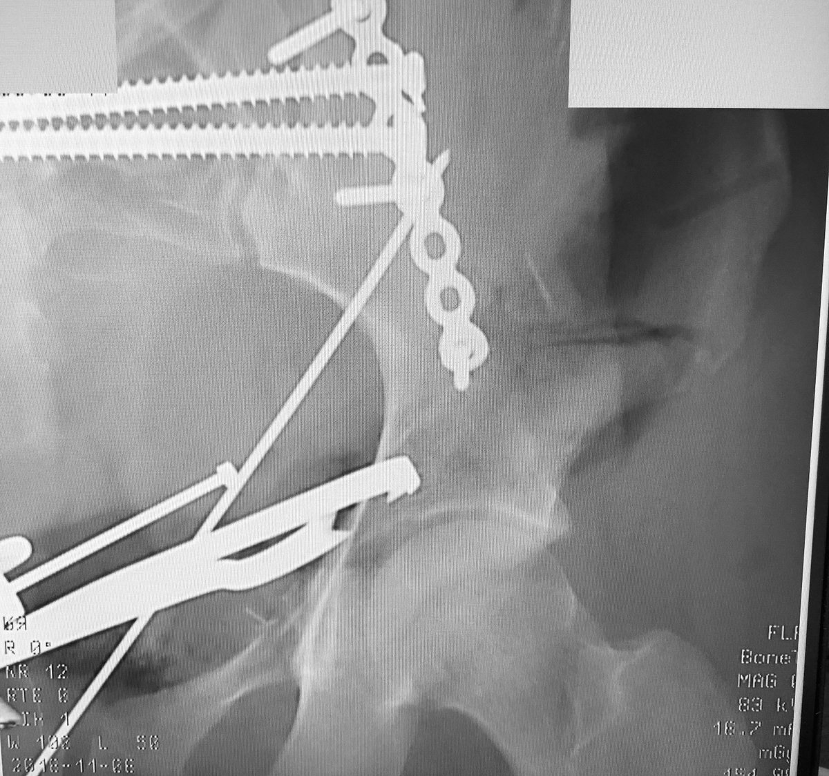 We used an ilioinguinal exposure on a regular table to clean the fracture surfaces and then reduce them - the AC is reduced and plated, and the PC is clamped prior to screw fixation - a sturdy wire helps to keep the PC reduced as well until the internal fixation construct is in