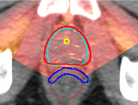Another of our #ThisIsBrachytherapy projects at St George - the use of deformable image registration to estimate the combined BT &amp; EBRT dose to OARs for combination therapy  in the treatment of prostate cancer. Lots of uncertainties, but it can be done!