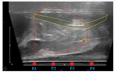 We routinely measure dose to the rectal wall in-vivo during HDR prostate brachy at St George. MOSkin dosimeters from <a href="/CMRPuow/">CMRP</a> are coupled to the TRUS probe and read-out in close to real-time, giving us confidence that our treatments are delivered accurately #ThisIsBrachytherapy