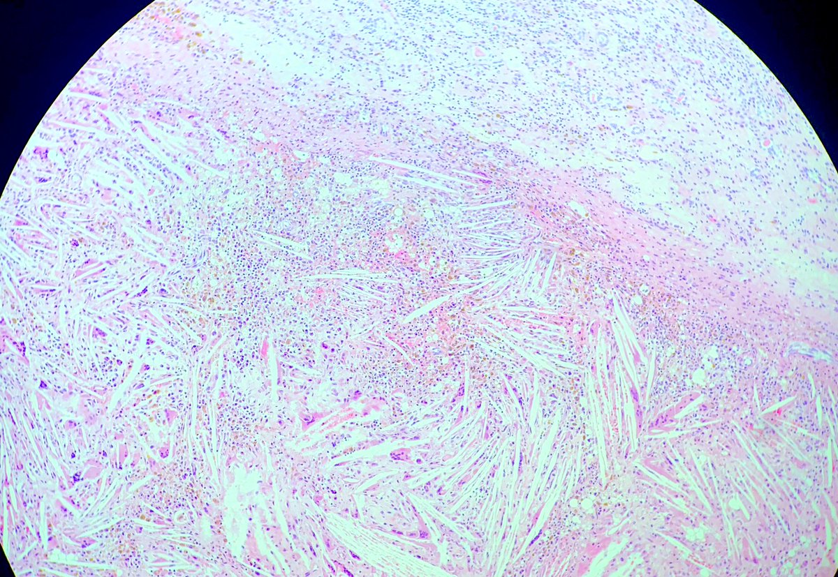 Xanthogranulomatous pyelonephritis #kidneypath #pathology #dermpath #cutecases #mondaychallenge is a rare form of chronic pyelonephritis, slightly more common in females. Associated with E. coli or Proteus, and often mistakenly taken as renal carcinoma by radiology