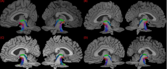 A probabilistic atlas of the locus coeruleus pathway to the transentorhinal cortex is now available thanks to Dr. Yonggang Shi and his team. sciencedirect.com/science/articl… 
#locuscoeruleus
