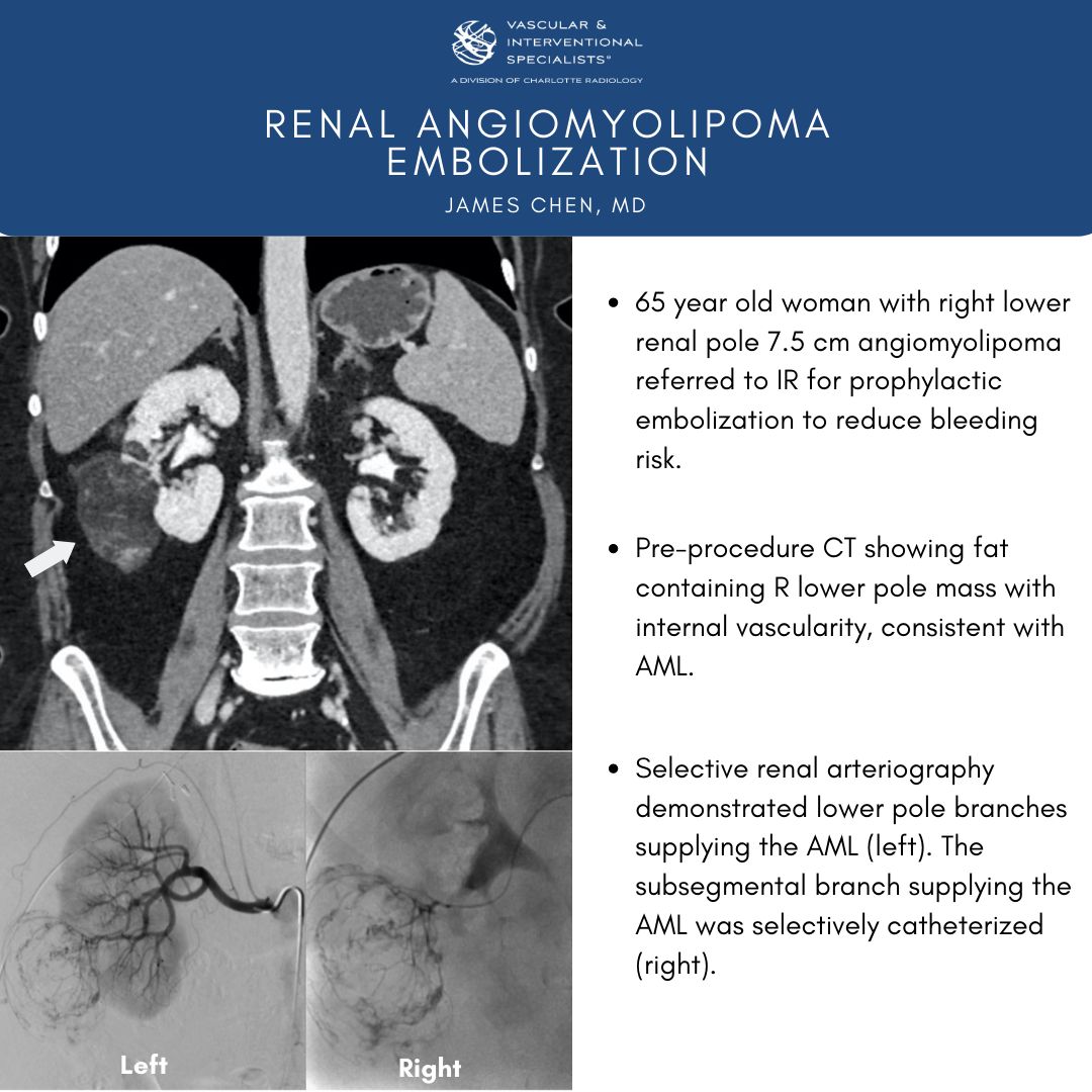 CLTRadiology's tweet photo. Did you know that our subspecialized #radiologists can perform minimally invasive procedures that have immediate results for patients? This Case Study Tuesday, @JamesChenMD shares his experience performing a renal angiomyolipoma embolization. #CaseStudyTuesday https://t.co/kAWkKR0AYS