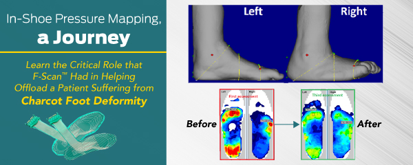 TekscanMedical's tweet photo. In this case study, David Sutton – a certified pedorthist and clinical advisor – shares his strategy for offloading a patient suffering from Charcot foot deformity with the help of in-shoe pressure .

https://t.co/kXCDiN2hXA https://t.co/X4Fn8Edk8U