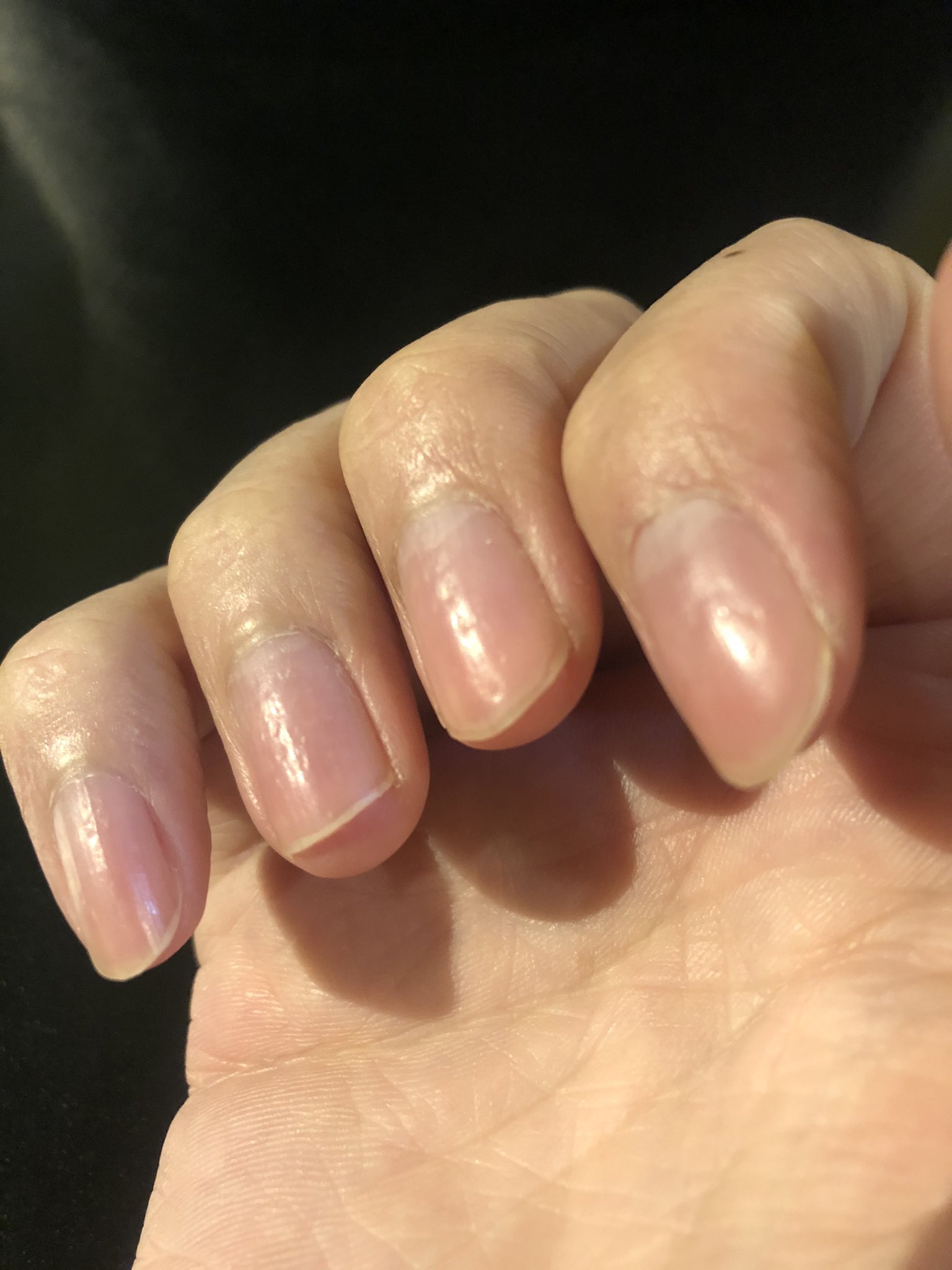 三好拓朗 Na Twitterze え 爪ボコボコなんだけど 栄養失調 なんこれ