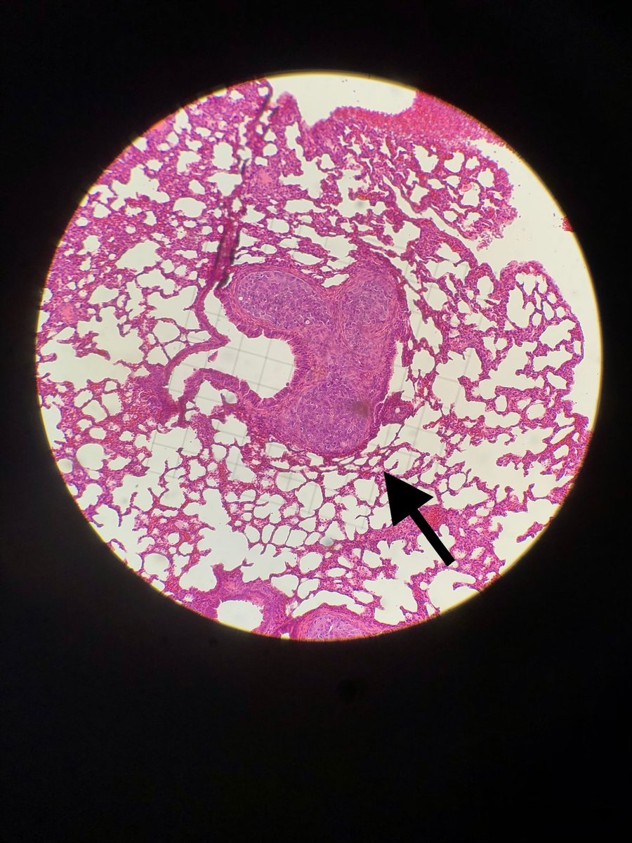 UAB Surgery (@uabsurgery) on Twitter photo Introducing my PIC, Dr. <a href="/RMarayati/">Raoud Marayati</a> aka one of the infamous "PIM👑s"! She is in her last year at @UABgradschool. She is looking at hepatoblastoma metastases (arrow) in lung sections from her in vivo experiment. Lucky to have received my basic science training from Chief Marayati! Introducing my PIC, Dr. <a href="/RMarayati/">Raoud Marayati</a> aka one of the infamous "PIM👑s"! She is in her last year at @UABgradschool. She is looking at hepatoblastoma metastases (arrow) in lung sections from her in vivo experiment. Lucky to have received my basic science training from Chief Marayati!