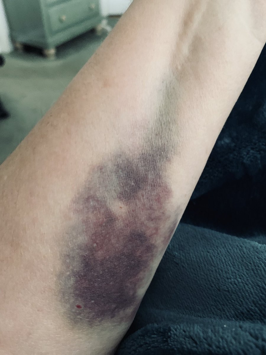 Echostar_K's tweet photo. @kulver I empathize. This is from a recent IV :( https://t.co/ktuZanYbJm