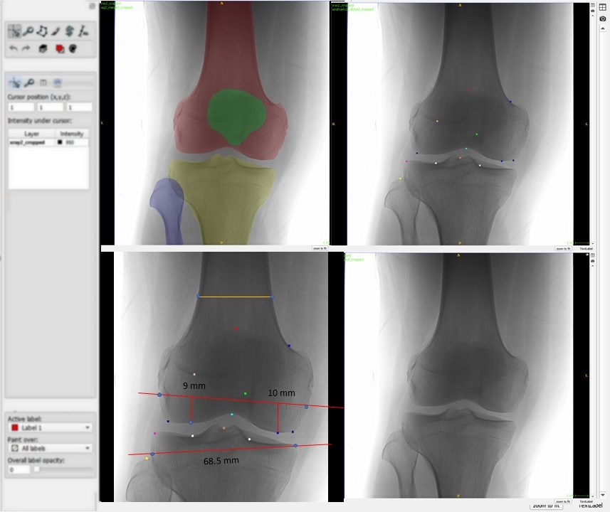 RSIPvision's tweet photo. Breakthrough announcement by @RSIPvision: accurate knee segmentation from X-ray with landmark detection ==> https://t.co/Vj8mS0XqkA
Take us along for your next Deep Learning project!
#orthopedics #orthopedicsurgery #kneereplacement #kneereplacementsurgery #AI #landmarkdetection https://t.co/7WHMSYeu9W