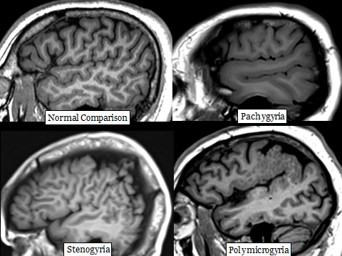 Hammerdongle's tweet photo. Dick's Pick of the Week: Cortical-Gyral Anomalies

Pachygyria, polymicrogyria, and stenogyria

#FOAMed #FOAMrad #radres #NeuroRad #radiology #Neurology https://t.co/jgk26A4kOb