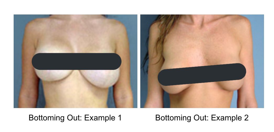 Bottoming out is when one or both implants are positioned too low or too lateral on the chest wall in relation to the nipple position. This means that the pocket, or capsule surrounding the implant has become too low on the chest wall or rests too far laterally when lying down.