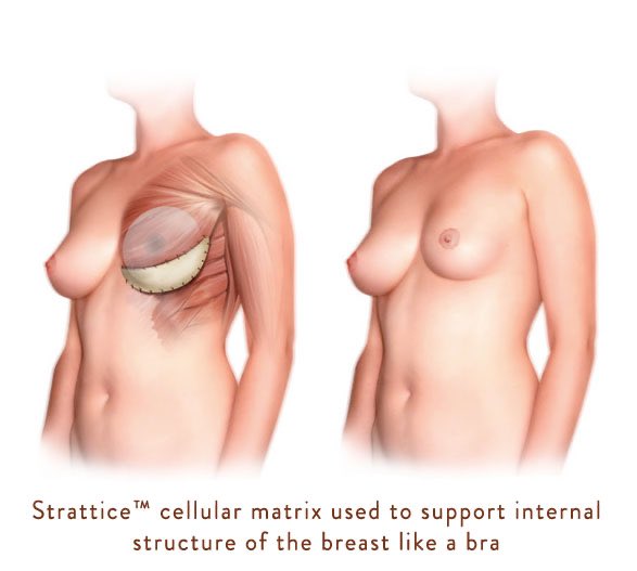 PLASTIC SURGERY CONSULTANT on X: An internal Bra is simply biodegradable  mesh scaffolding placed under the breast tissue. When it breaks down it  forms a strong , firm layer of tissue. This