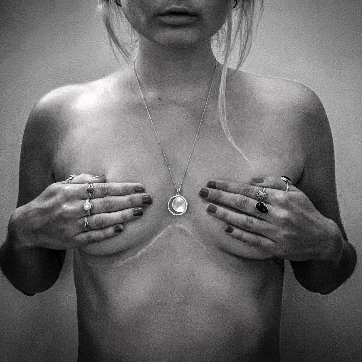 hollyrosanna's tweet photo. 5 years, 6 months and 27 days of extra time thanks to my organ donor. The scars may fade but the gratitude I feel for my donor and medical teams for saving my life just continues to grow as time passes, time I didn’t think I’d have. #livelifegivelife #organdonation #doublelung https://t.co/n0Dfau6T6v